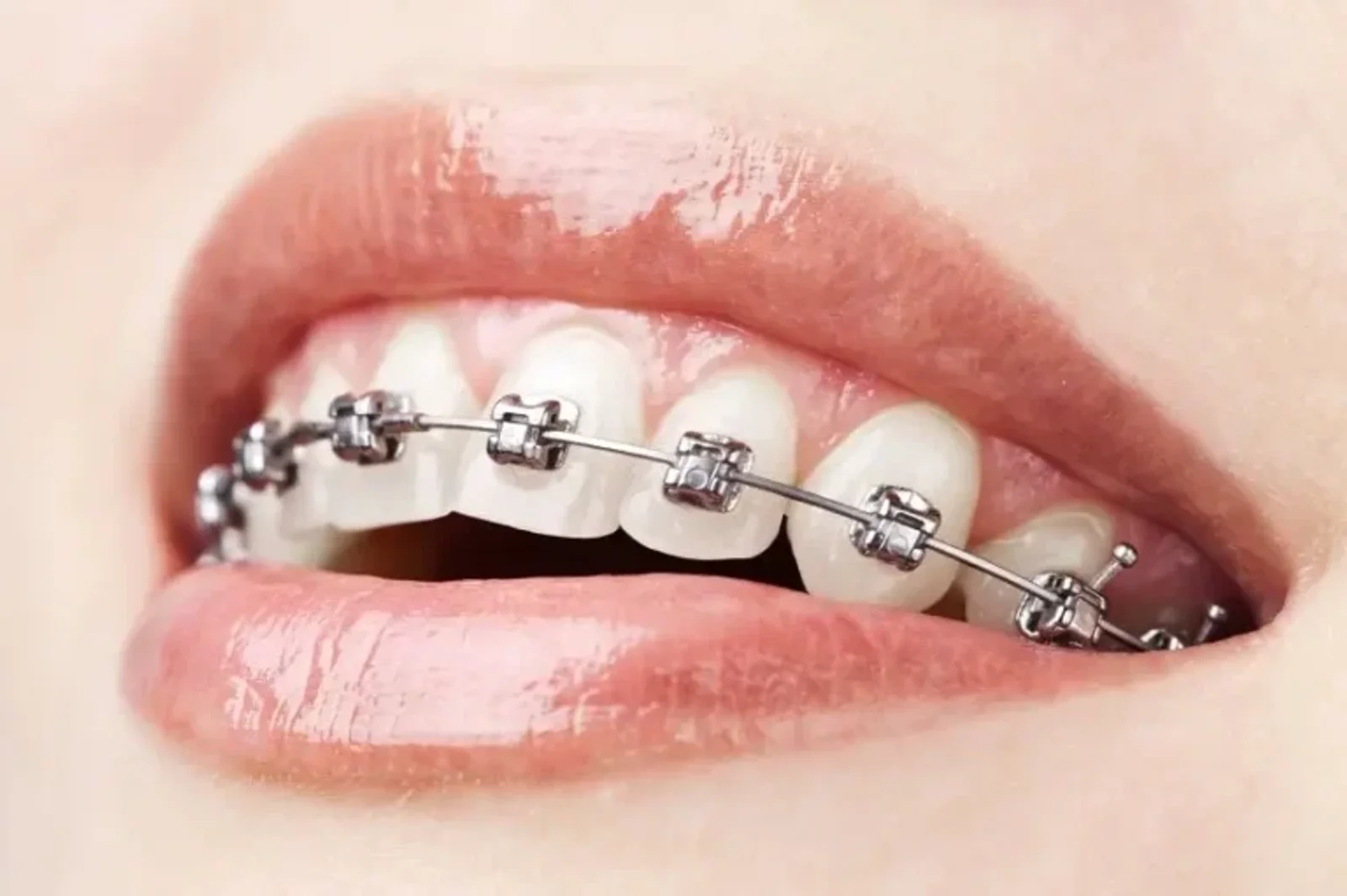 Guide to Braces for Dental Assistant Students- Learn Orthodontic Basics
