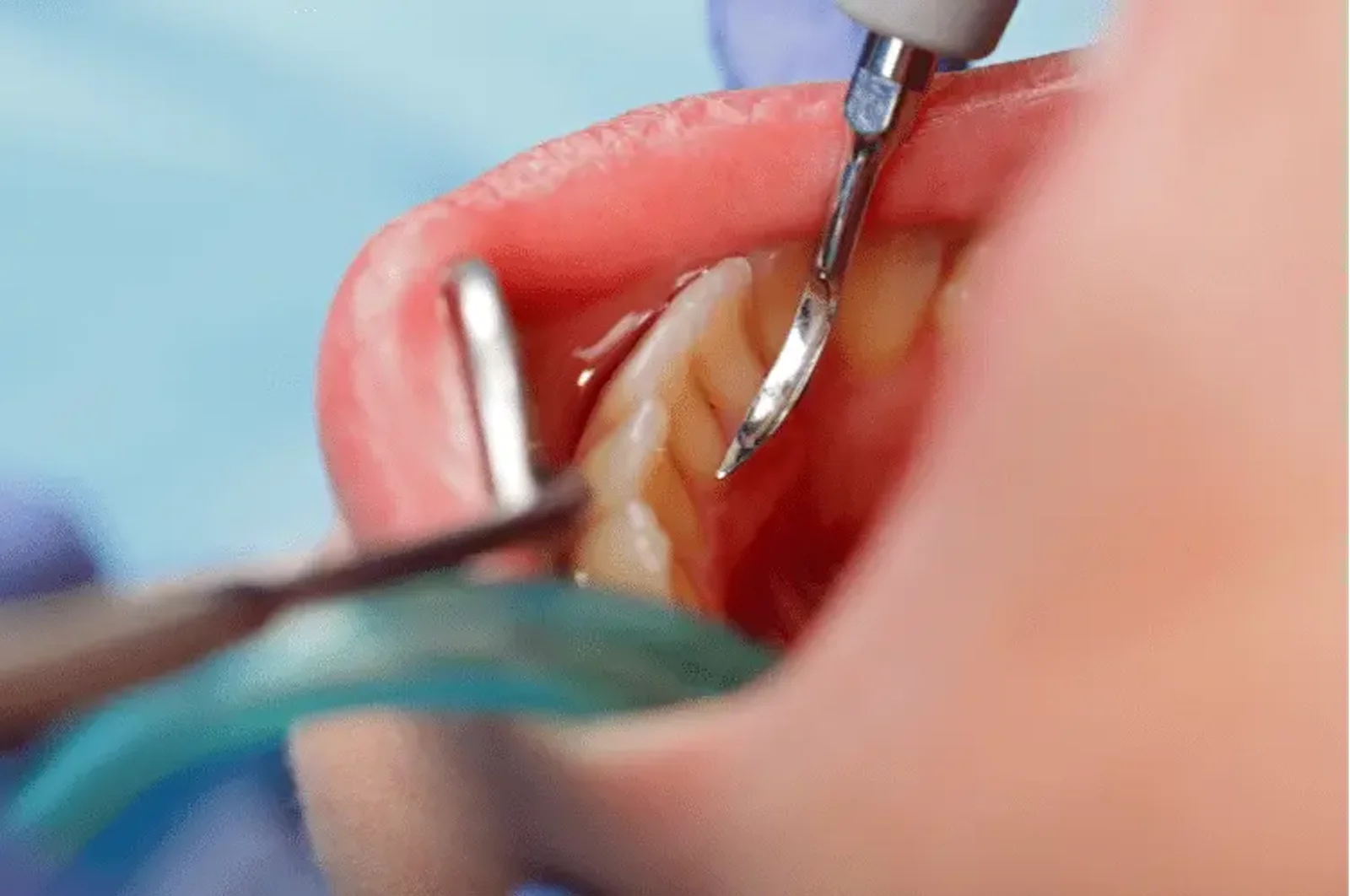 Gum Disease and Prevention Strategies for Dental Assistants
